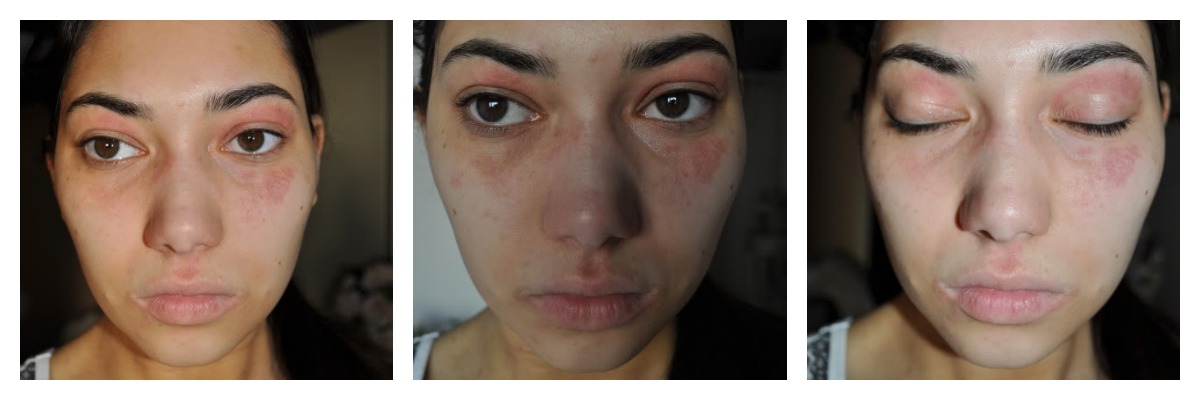 living with eczema and allergies